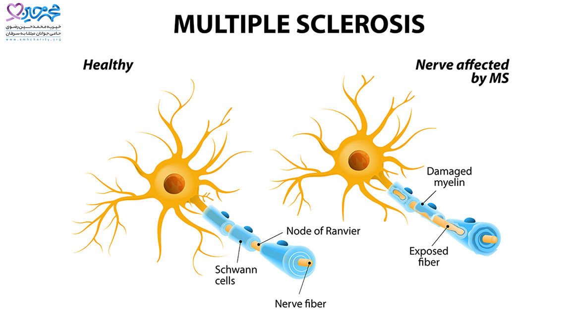 درمان بیماری ام اس
