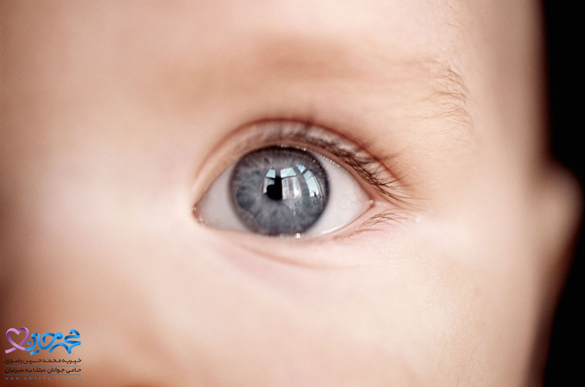 سرطان چشم در کودکان