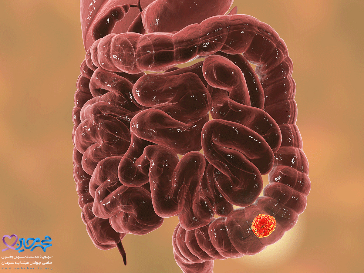 عوامل ایجاد سرطان روده متاستاتیک 
