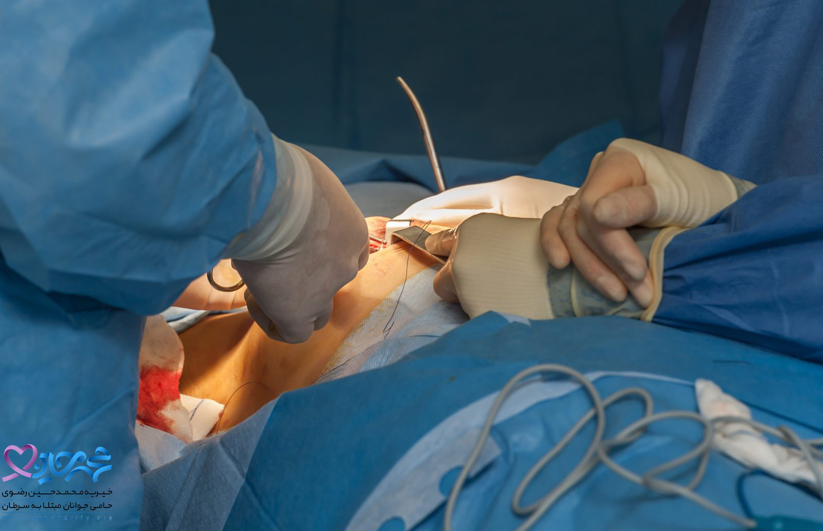 موارد مؤثر در جراحی سرطان سینه