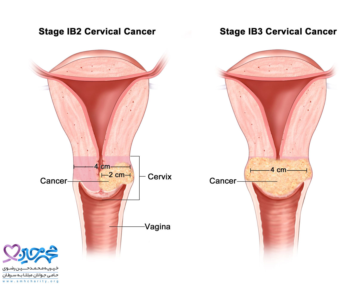 مراحل سرطان واژن
