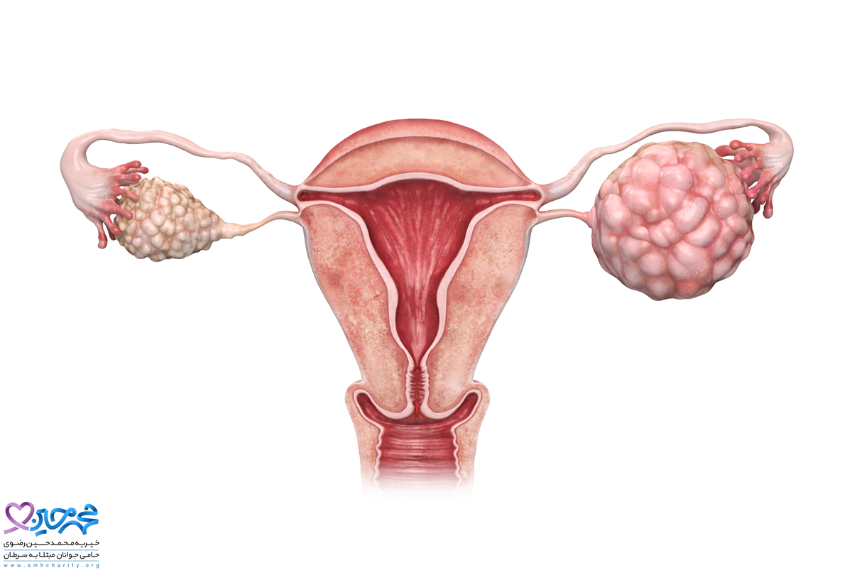 درمان سرطان تخمدان