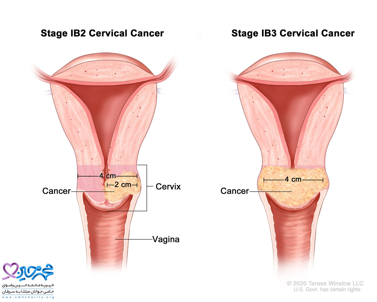 علائم ابتلا به سرطان دهانه رحم