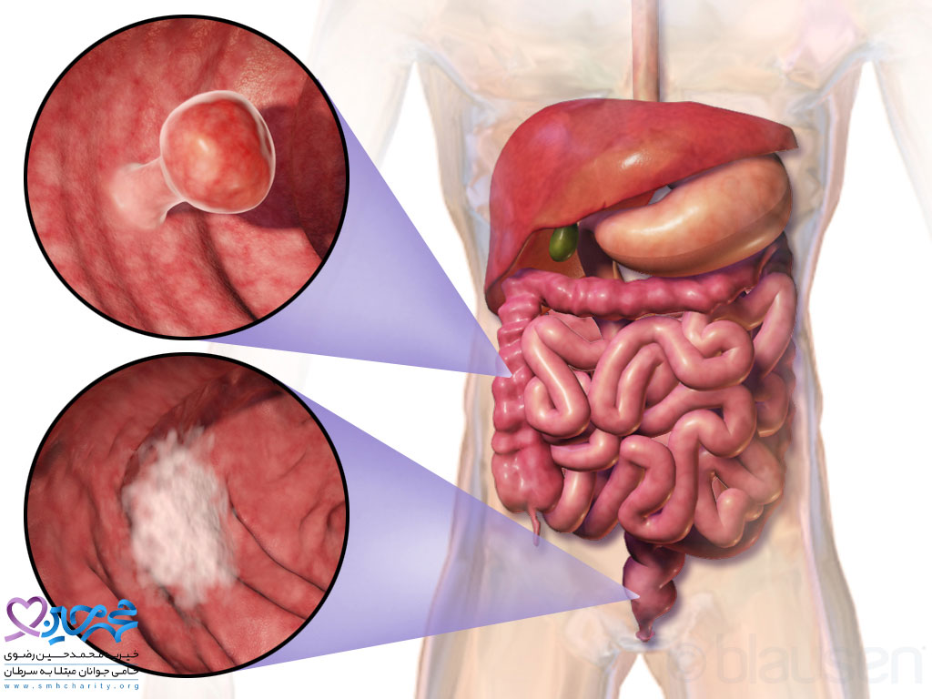 نشانه هشدار دهنده افزایش سرطان گوارش در مردان