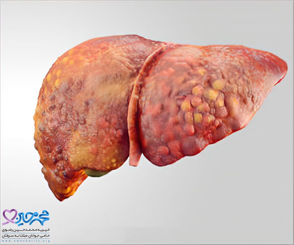 انواع سرطان کبد چیست