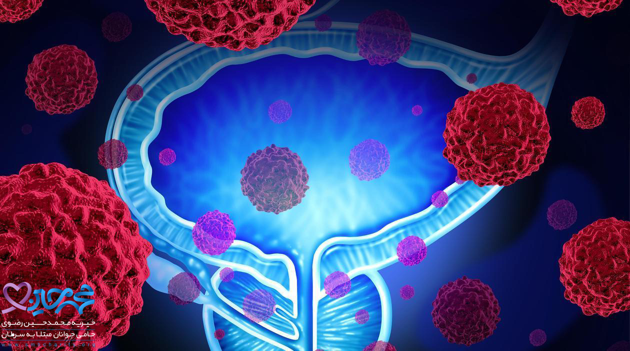 پیشگیری و درمان به موقع سرطان پروستات