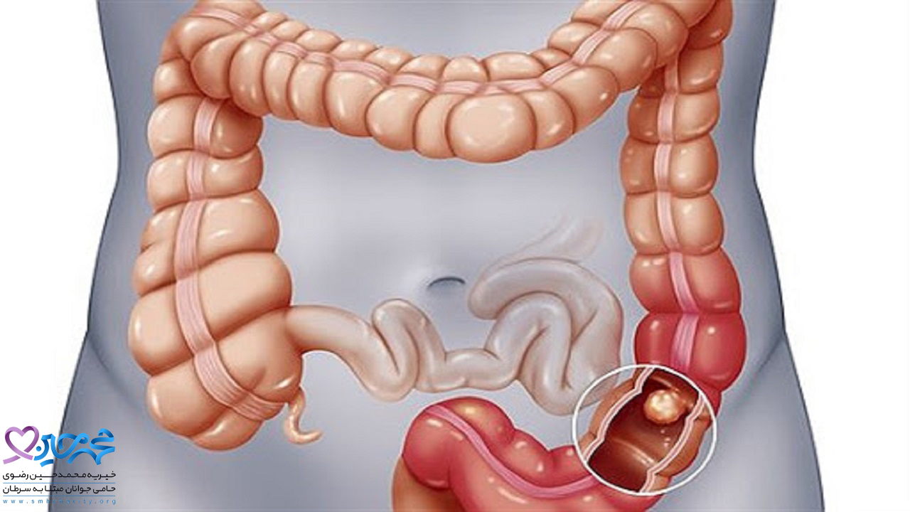 عوارض احتمالی پس از جراحی روده