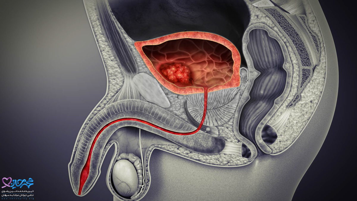 انوع سرطان مثانه