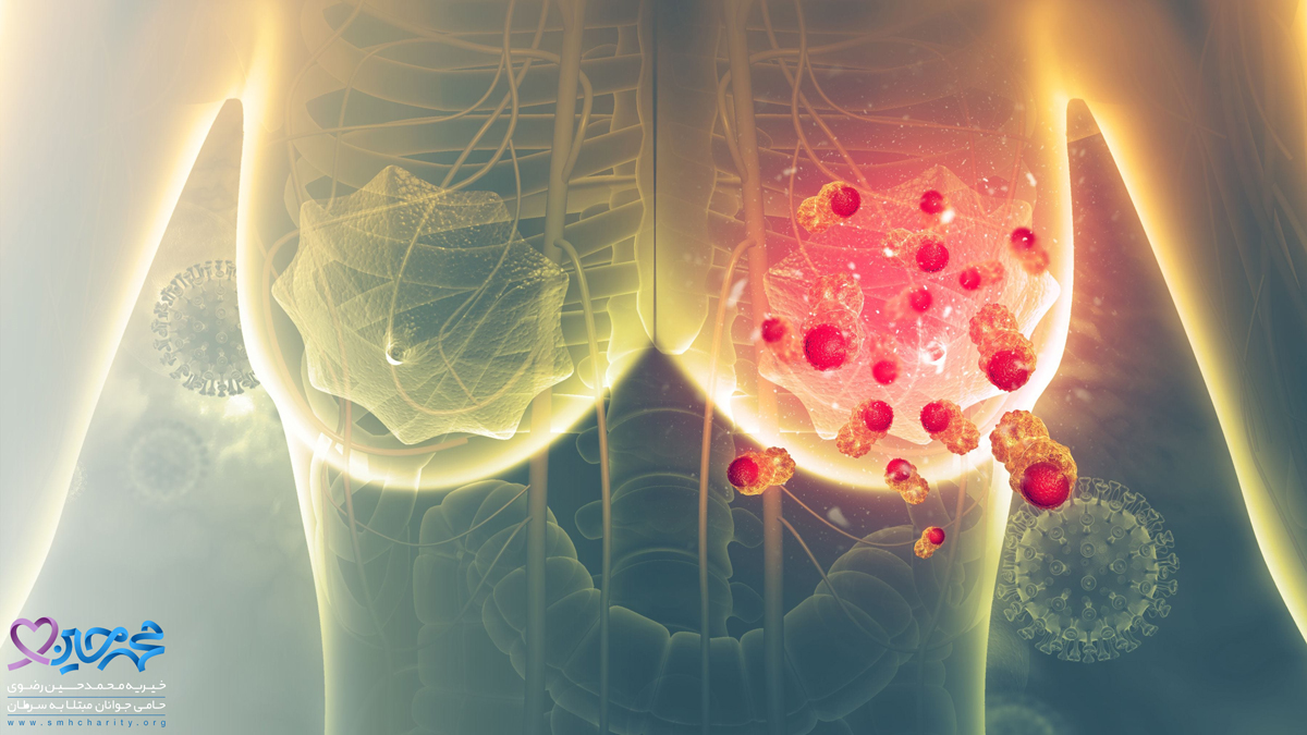 سرطان تهاجمی سینه