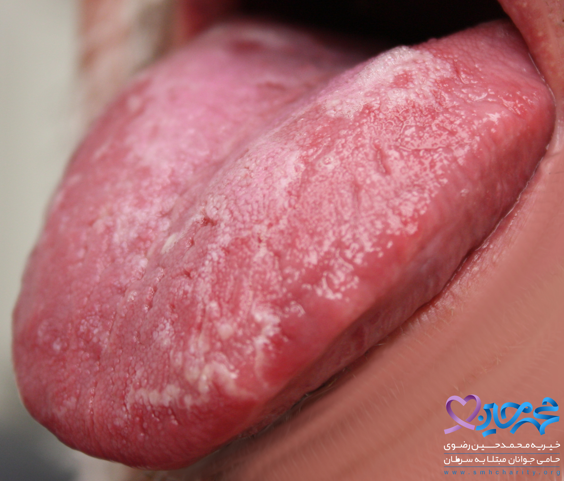 سرطان تهاجمی زبان