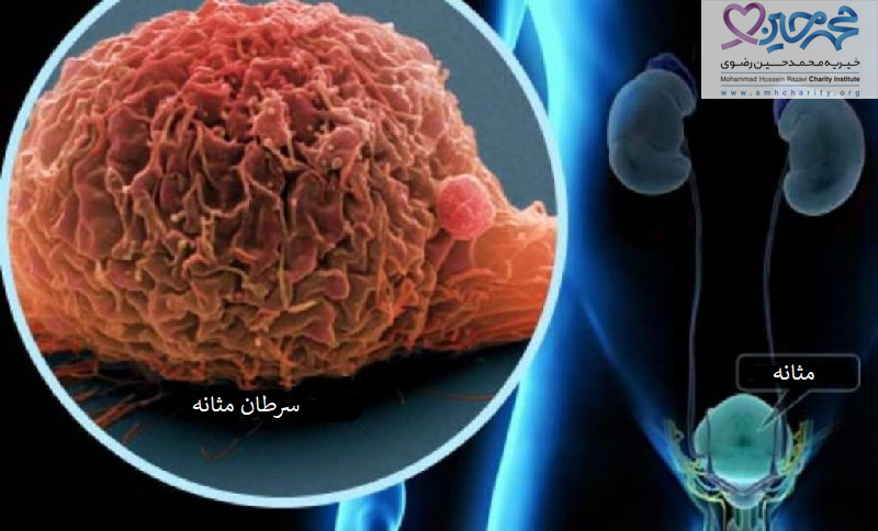 سرطان مثانه| درمان سرطان مثانه
