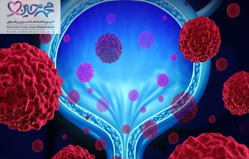 سرطان مثانه| درمان سرطان مثانه
