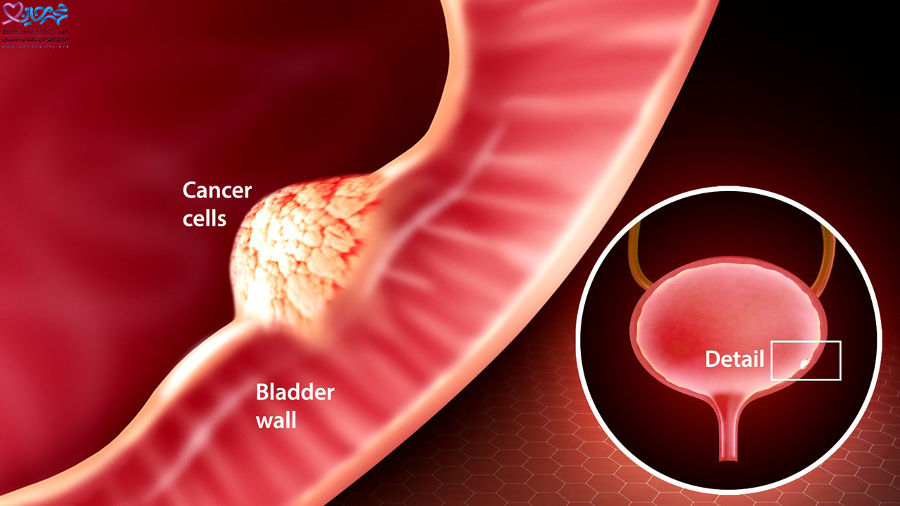 علت ابتلای سرطان مثانه| سرطان مثانه در مردان| ابتلا به سرطان| درمان سرطان مثانه