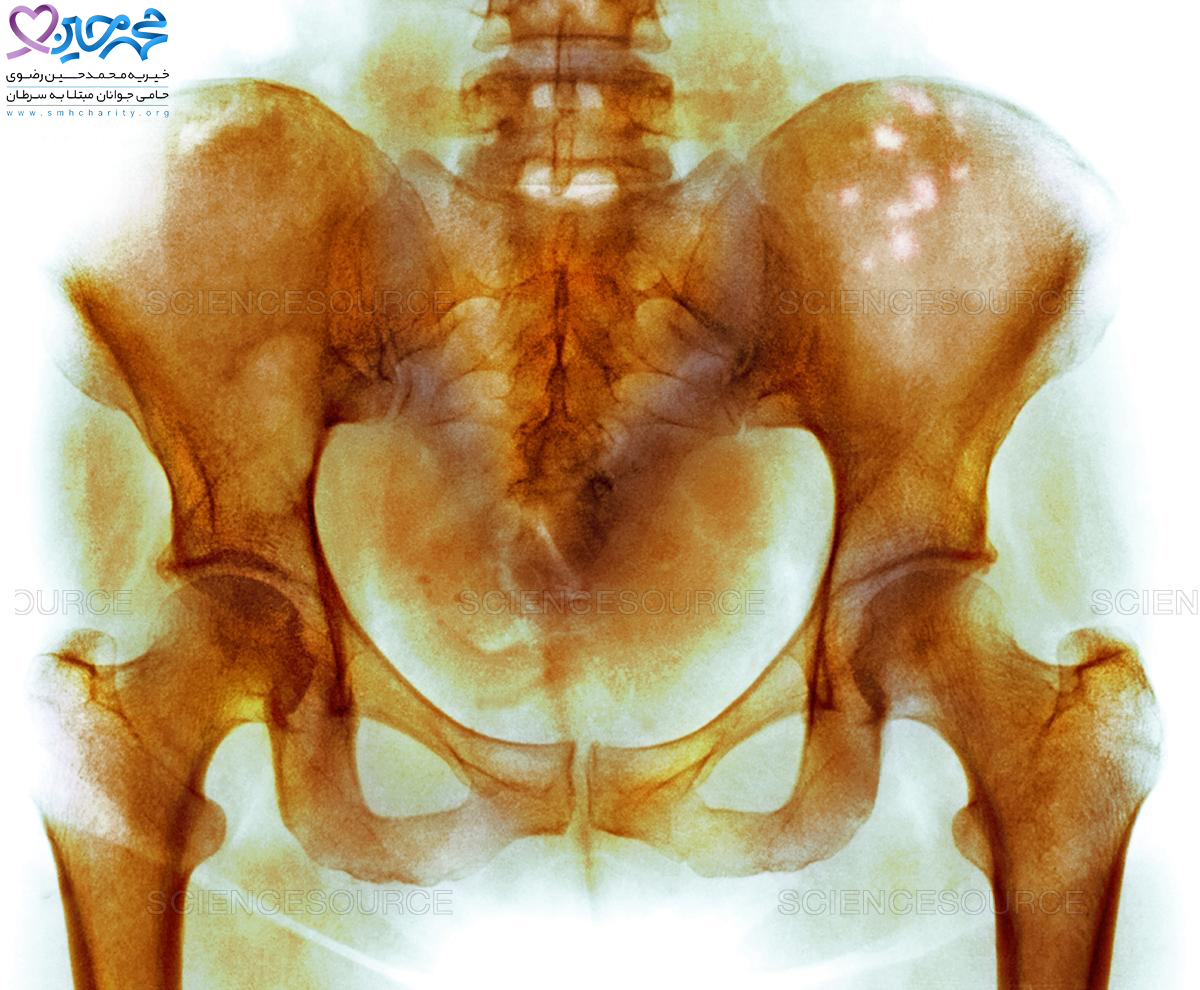 سرطان مغز استخوان| درمان سرطان| پیشگیری از سرطان مغزاستخوان| ابتلا به سرطان