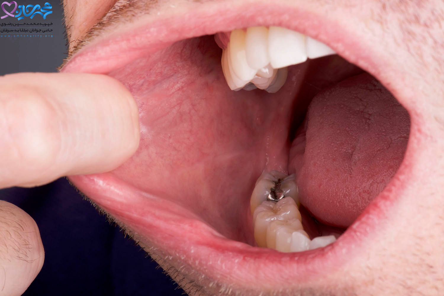 میزان عمر افراد مبتلا به سرطان دهان چقدر است؟