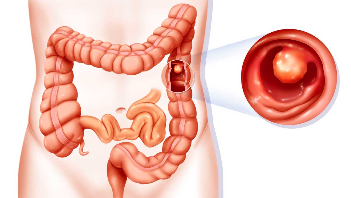 سرطان کولون| درمان سرطان مقعد| پیشگیری از سرطان| علائم سرطان کولون