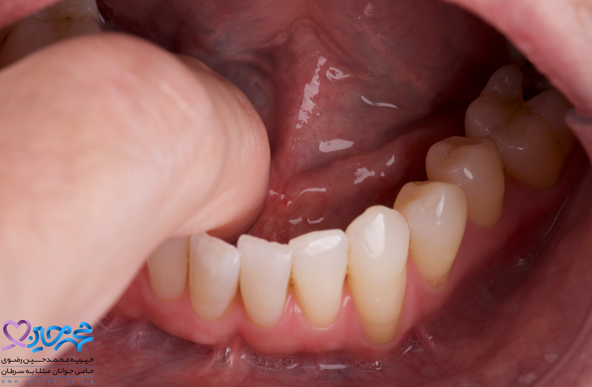 مراحل سرطان زبان 