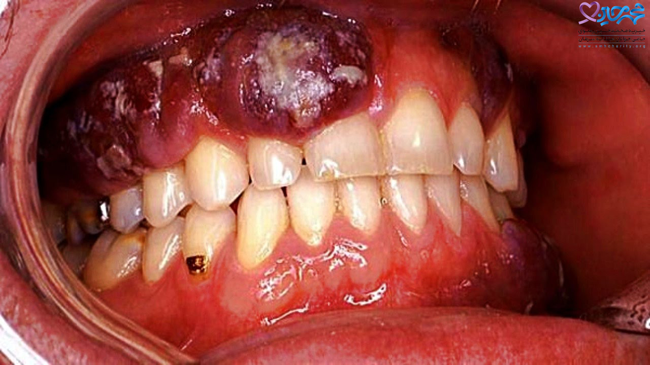 سرطان لثه| سرطان دهان | سرطان | انواع سرطان | علائم سرطان لثه