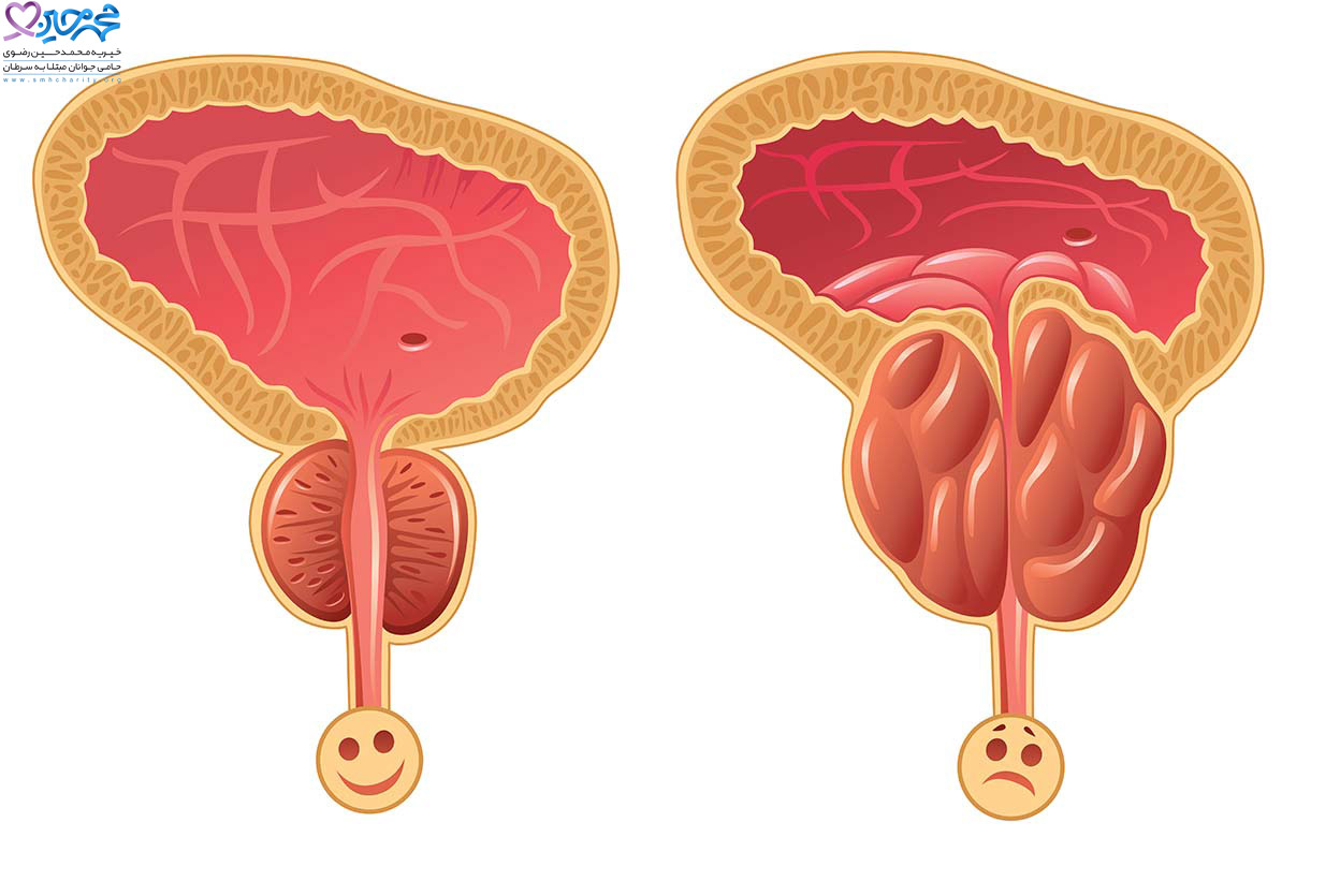 سرطان پروستات چیست؟