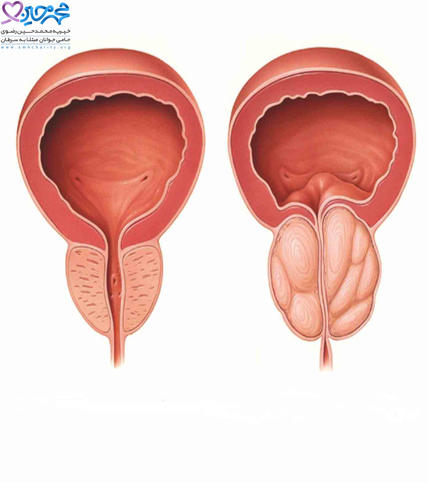 درمان بزرگی خوش خیم پروستات