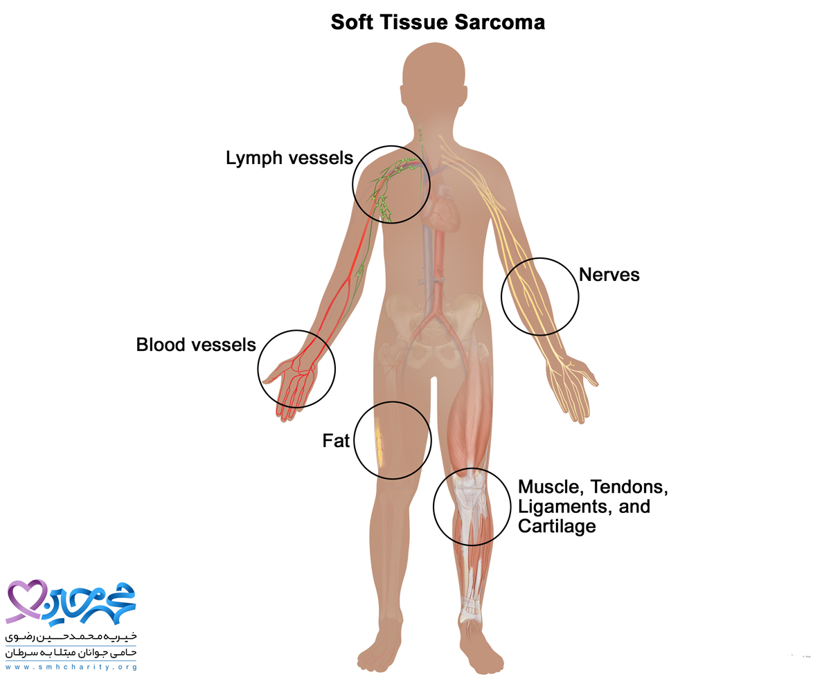 علائم سرطان ساکوم