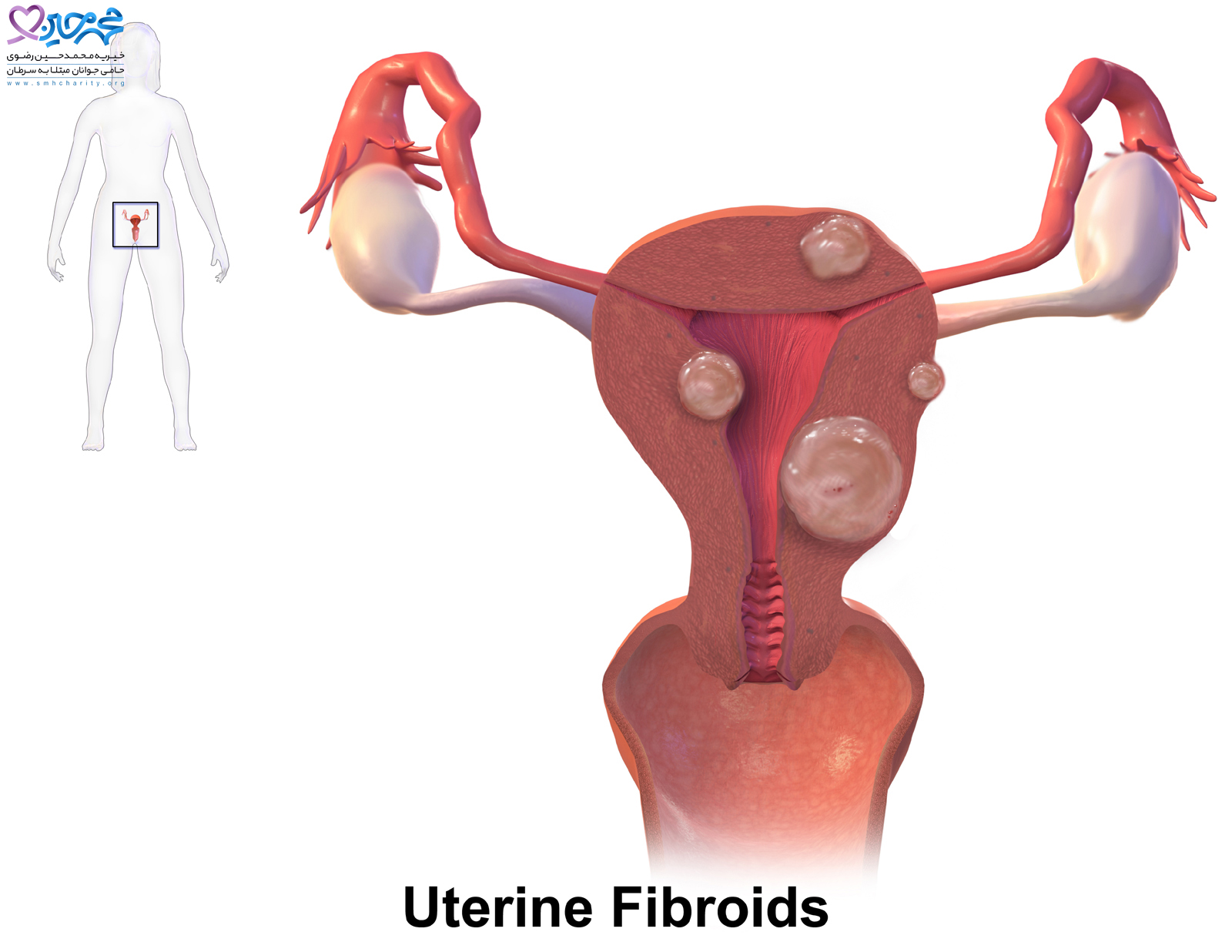 فیبروم رحم| سرطان رحم| بیماری رحم