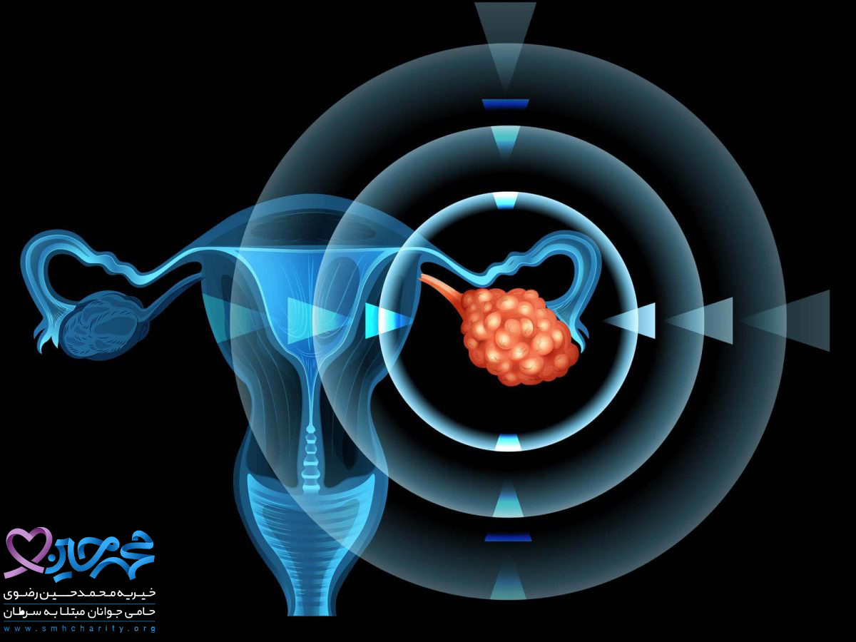علائم سرطان تخمدان