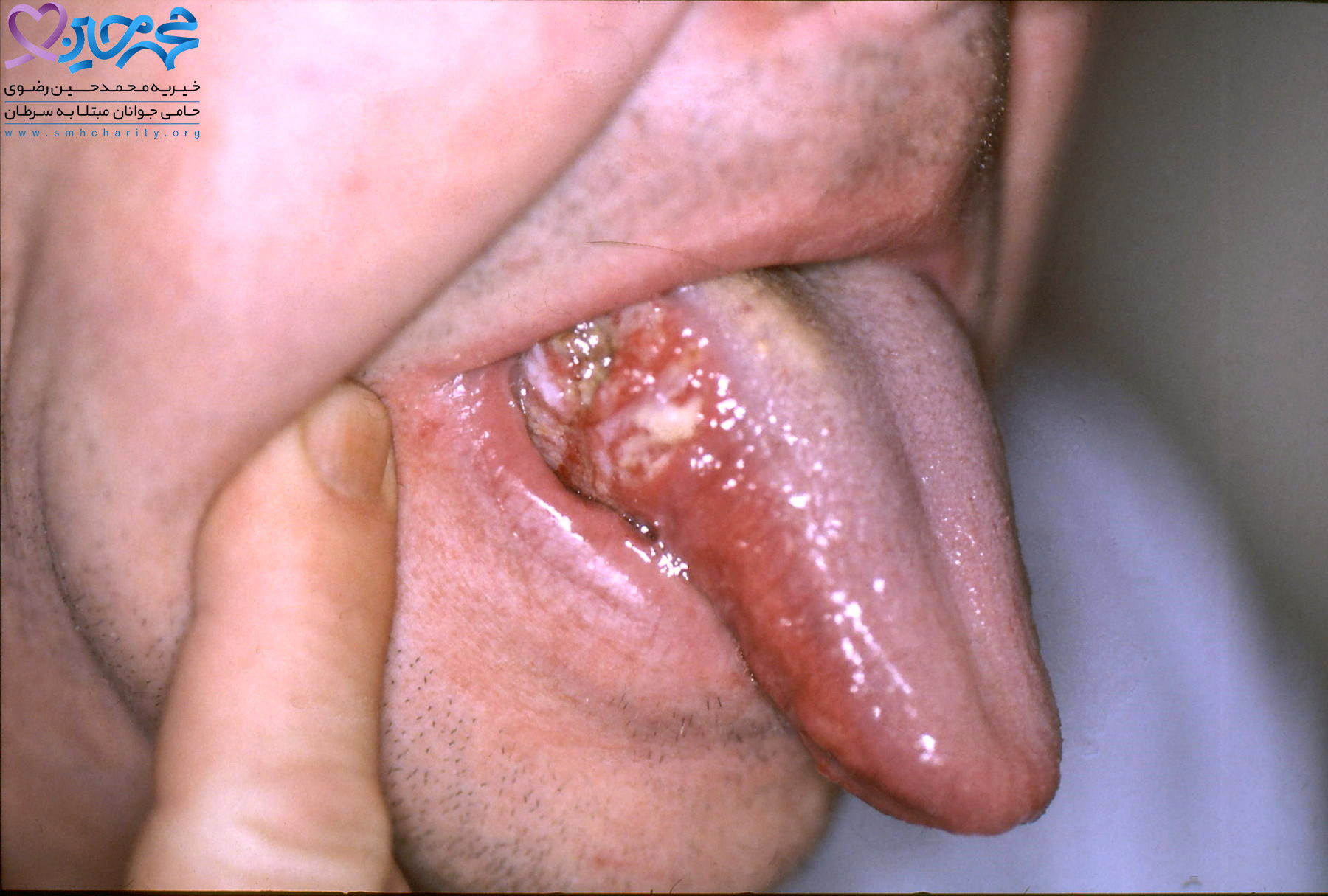ریکاوری پس از درمان سرطان دهان