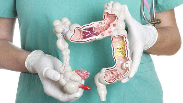 آشنایی بیشتر با سرطان روده
