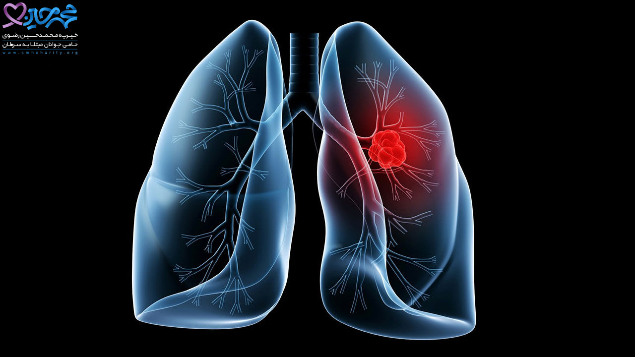 سرطان ریه|پیشگیری از سرطان ریه|درمان سرطان ریه|سرطان ریه در زنان|نشانه های سرطان ریه در زنان و مردان|بروز نشانه های سرطان ریه در زنان|نشانه های سرطان ریه در زنان سیگاری|