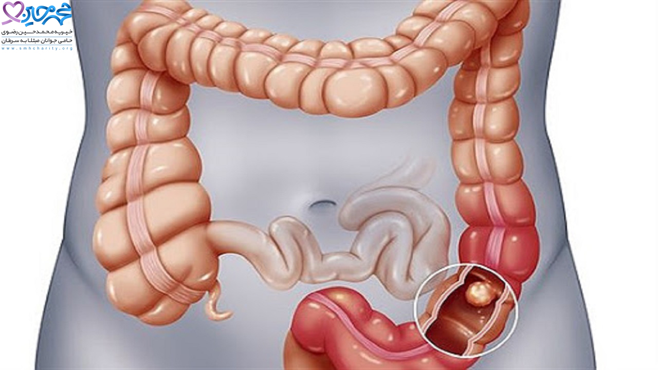 سرطان‌ روده ‌بزرگ|دلایل ابتلا به سرطان‌ روده ‌بزرگ|کولونوسکوپی|سرطان روده بزرگ|