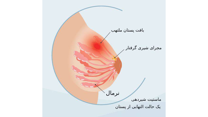 سرطان سینه| درمان سرطان| علائم سرطان سینه