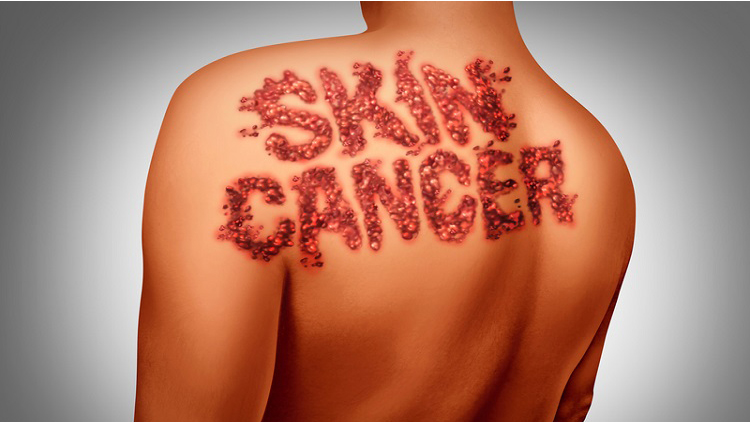 سرطان پوست چیست؟ 
