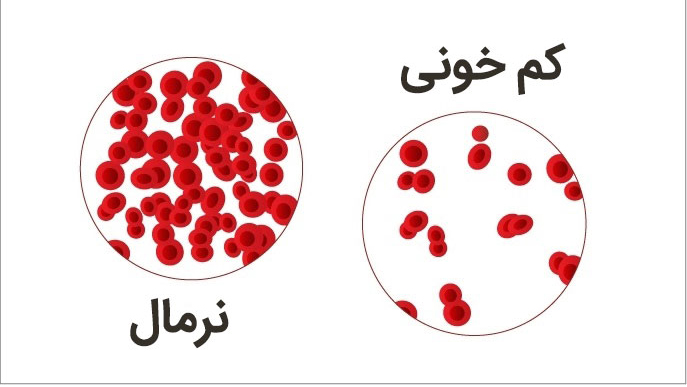 کم خونی| درمان کم خونی | کم خونی چیست؟ | علامت های کم خونی کدام اند ؟ | درمان کم خونی با خوردن موادغذایی مفید