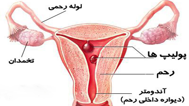 سرطان آندومتر و درمان آن