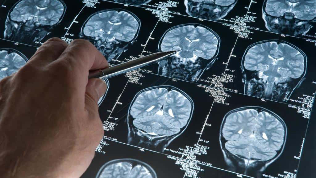 سردردهای تومور مغزی چیست؟ 