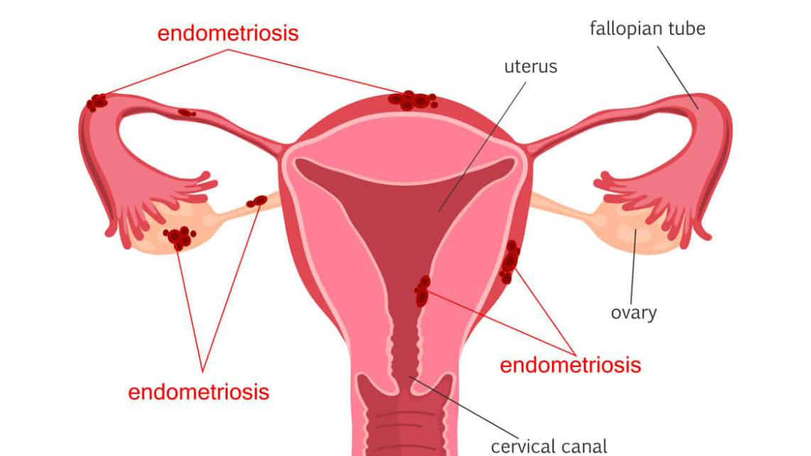 علائم آندومتریوز از درد لگن تا ناباروری