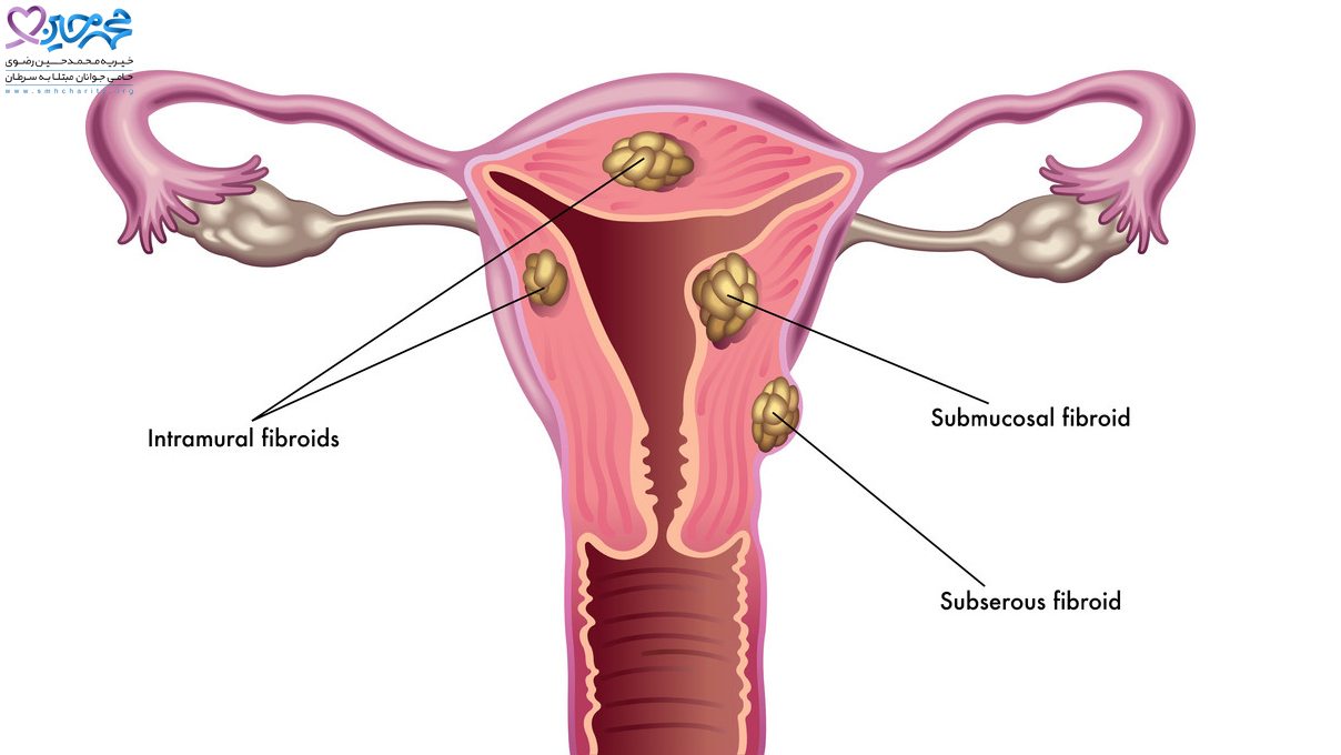 فیبروم رحم| فیبروم رحم| سرطان رحم| بیماری رحم| پیشگیری از فیبروم رحم| فیبروم رحم چیست