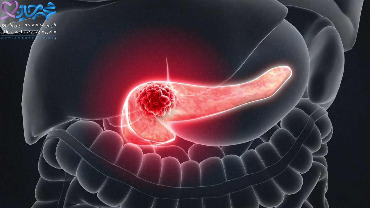 سرطان پانکراس|درمان سرطان پانکراس|نشانه های خاموش سرطان پانکراس|علائم سرطان پانکراس|پیشگیری از سرطان پانکراس