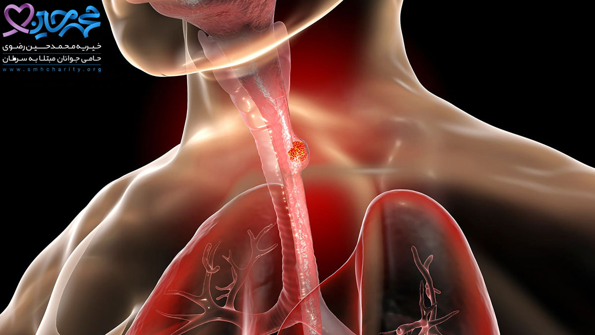 علائم سرطان مری ؛ علل و راهکار آن