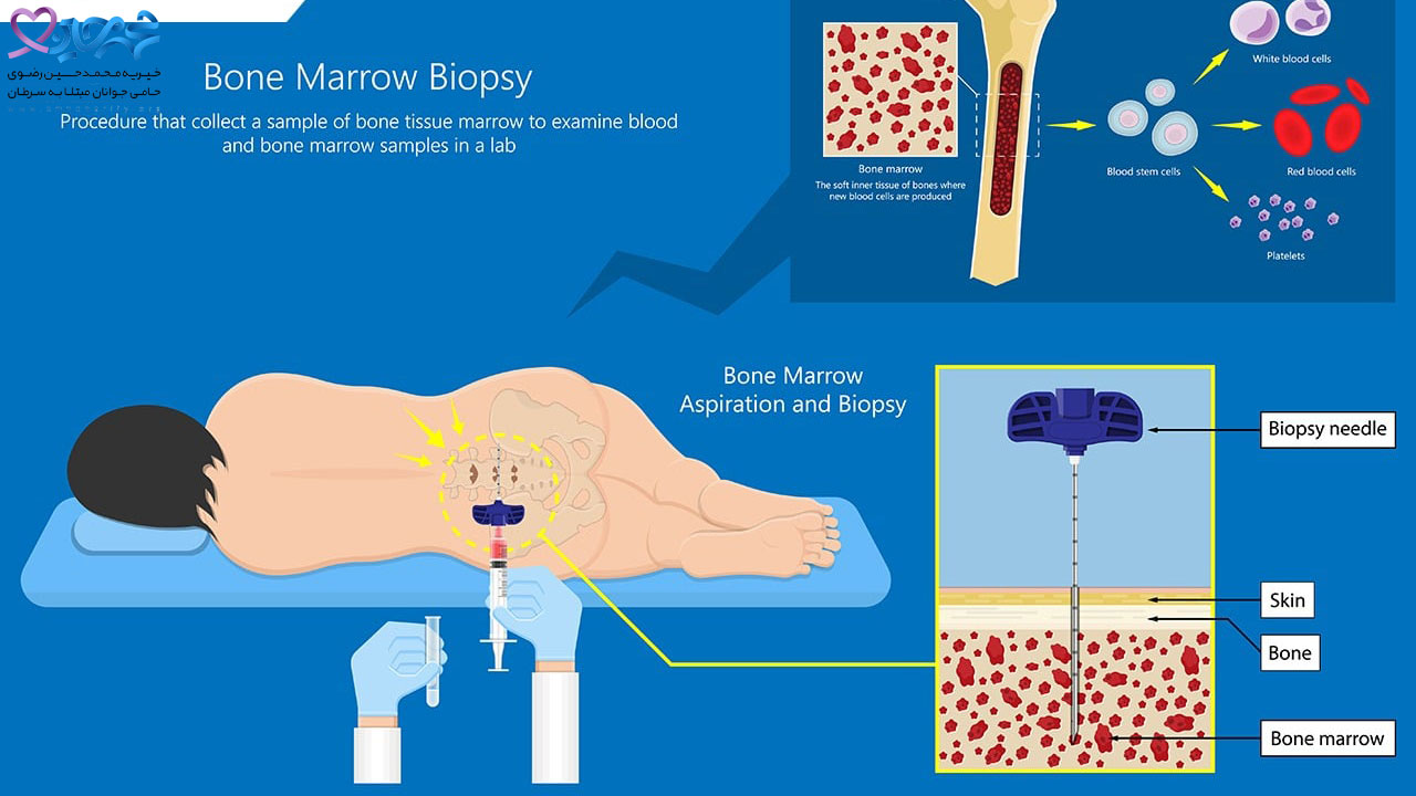 پیوند مغز استخوان|سرطان خون|درمان سرطان|پیوند مغز استخوان چیست|روش‌های پیوند مغز استخوان