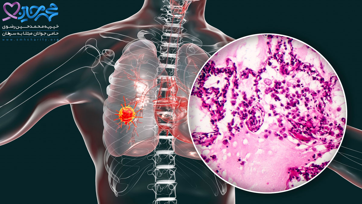 سرطان ریه|پیشگیری از سرطان ریه|