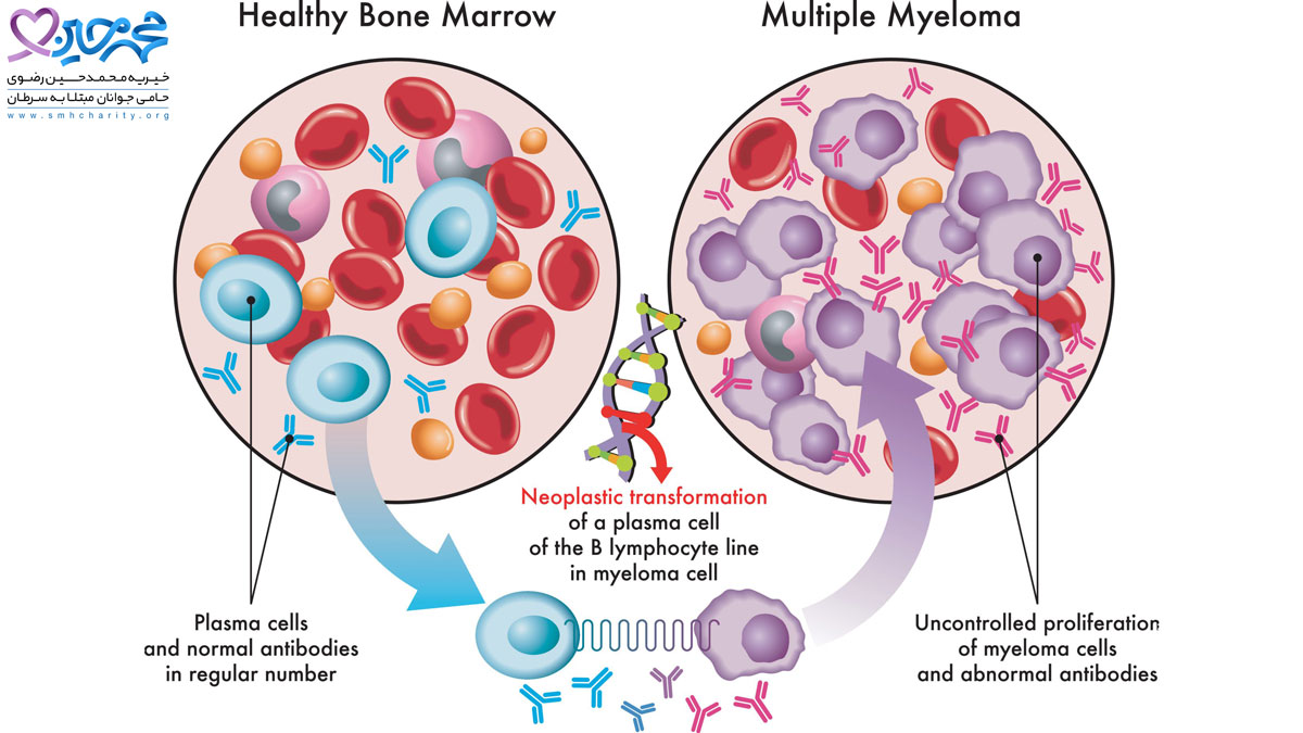 درباره بیماری مولتیپل میلوما بیشتر بدانیم
