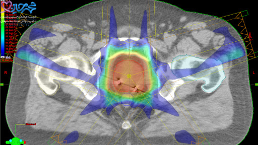 درمان سرطان با IMRT