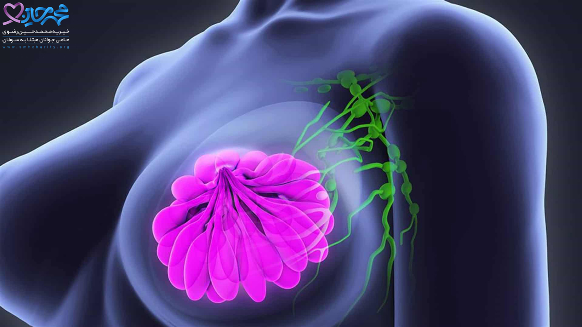  انواع نادر شایع سرطان سینه