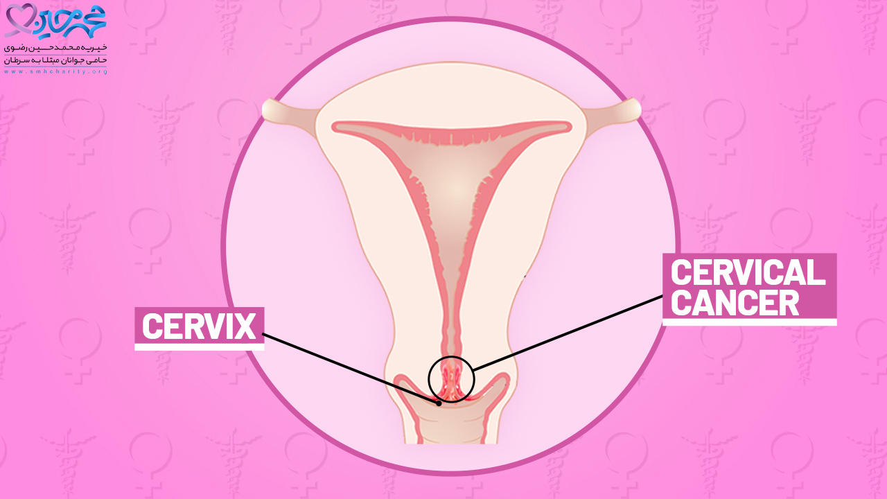 عوامل ایجاد کننده سرطان سرویکس چه می باشد