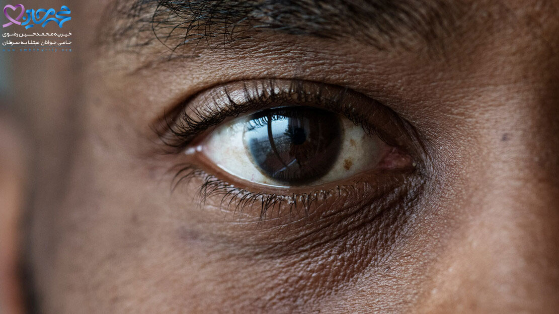 عوامل موثر در بروز سرطان چشم و فرسودگی شبکیه