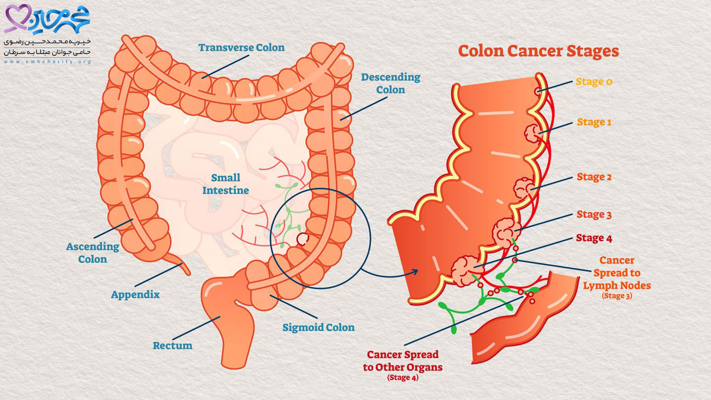 سرطان روده بزرگ چیست|مراحل پیشرفت  سرطان روده بزرگ|متاستاز سرطان روده بزرگ