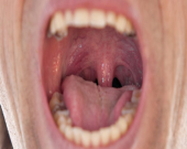 سرطان دهان و علائم آن