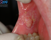  آیا سرطان دهان کشنده است؟